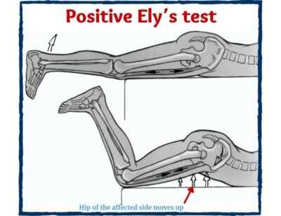 Ely S Test Positive Ely S Test Technique Nurseship