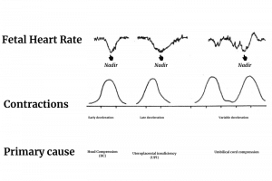 Fetal Heart Rate Monitoring and VEAL CHOP MINE in Nursing - Nurseship.com