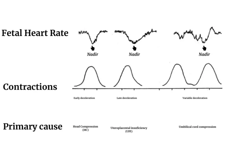 Fetal Heart Rate Monitoring and VEAL CHOP MINE in Nursing