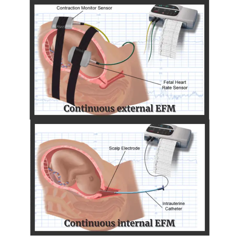 continuous-electronic-fetal-heart-rate-monitoring