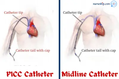 Midline Catheter vs Peripherally Inserted Central Catheters (PICC ...