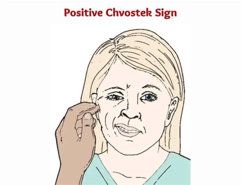 Chvostek-Sign-positive-Chvostek-Sign-Chvostek's-SignChvostek-Sign-assessment-causes-of-chvostek-sign