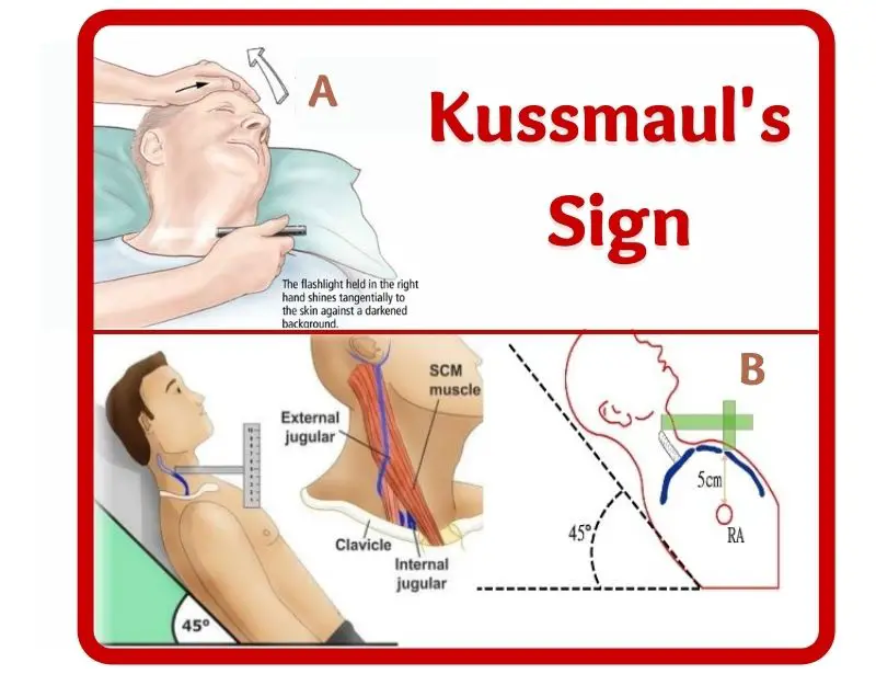 Kussmaul-sign-Kussmaul's-sign-causes-what is kussmaul sign