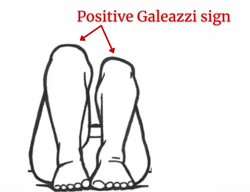 galeazzi sign-Allis sign-positive galeazzi sign-positive allis sign