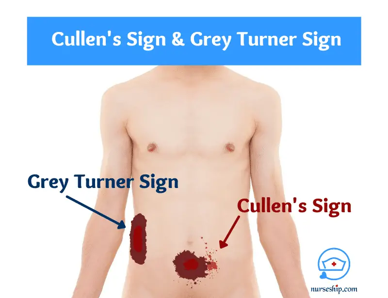 cullen's sign-cullen sign-cullen's sign picture-cullen's sign and grey turner's sign-positive cullen sign-cullen's sign may be indicative of-cullen's sign causes