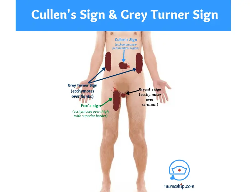grey turner sign, grey turner's sign, fox's sign, cullen's sign and grey turner's sign, grey turner sign causes, fox's sign pancreatitis, bryant’s sign