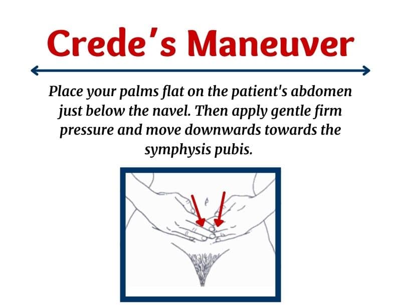 crede maneuver-crede's maneuver-credé maneuver-crede maneuver for bladder
