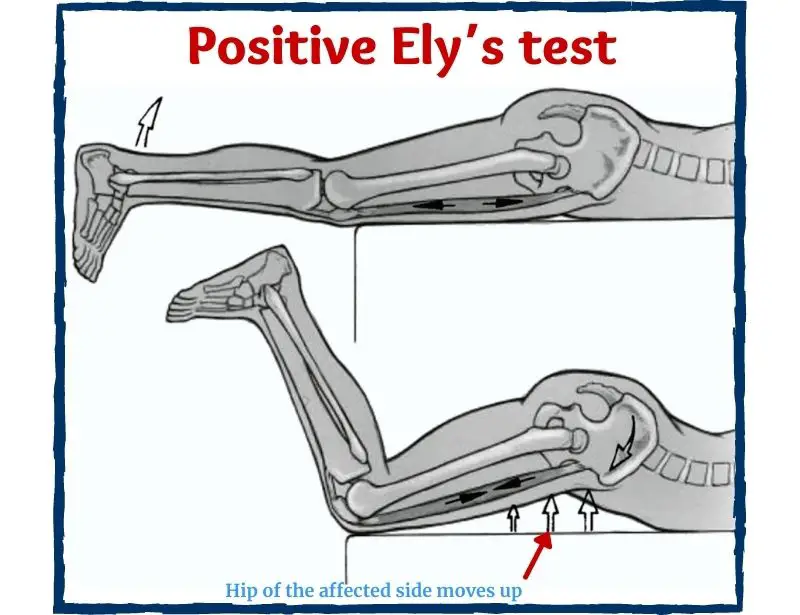 elys-test-positive-elys-test-what-is-elys-test-elys-test-orthopedic