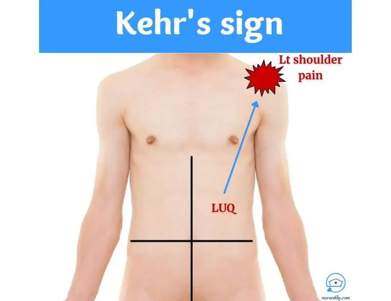 kehrs-sign-kehr-sign-definition-kehrs-sign-positive-what is kehr's sign-kehr's sign right shoulder-+ kehr's sign