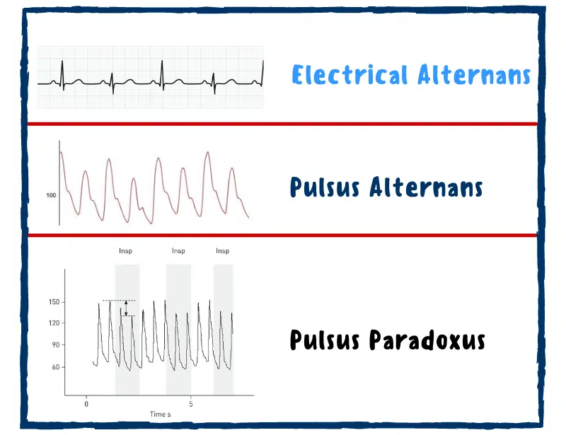 pulsus-alternans-ecg-pulsus-alternans-vs-pulsus-paradoxus-electrical-alternans-vs-pulsus-alternans-pulsus-alternans-vs-Pulsus-bigeminus-pulsus-paradoxus-electrical-ecg-electrical-alternans-ecg