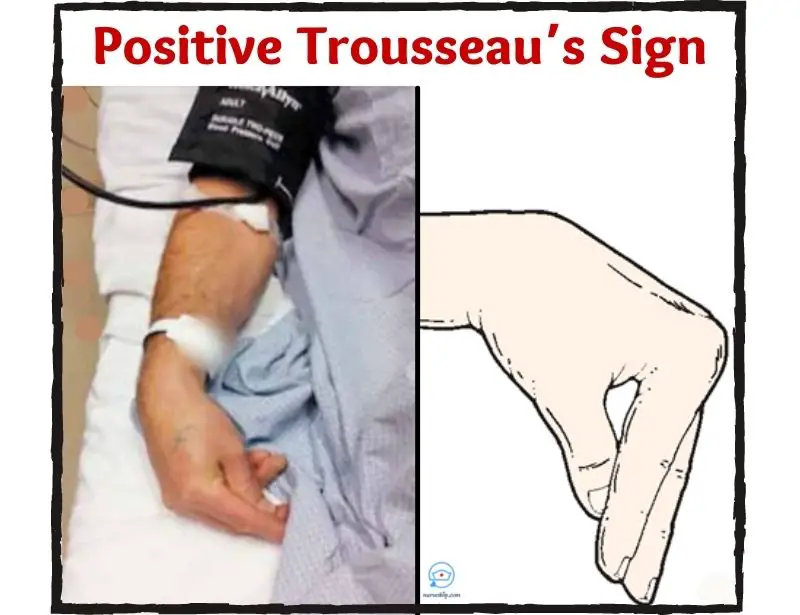 Trousseaus Sign Causes Assessment Treatment