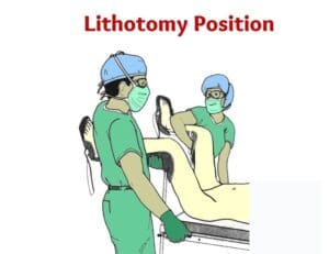 lithotomy position- dorsal lithotomy position- lithotomy position image- lithotomy position photo- dorsal lithotomy position picture- 