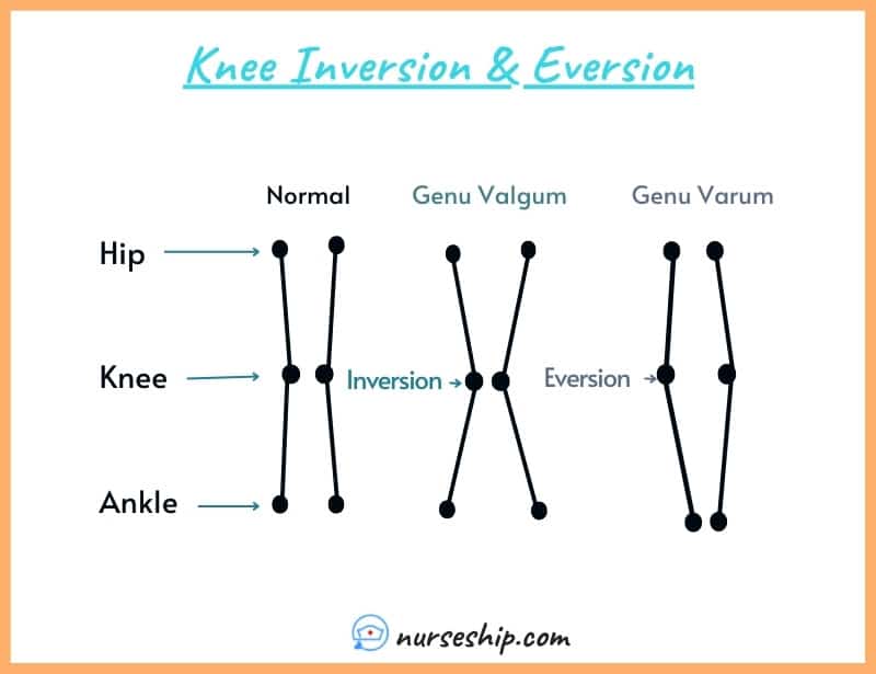 knee-inversion-vs-eversion-genu-valgum-genu-varum-foot-ankle-inversion-of-foot-eversion-definition-anatomy-muscles-nerves-diagram-calcaneal-inversion-of-ankle-sprain-inury-normal-range-of-motion-subtalar-eversion-what-is-foot-eversion-meaning-image-with-pics-a&p-angular-movement-musculosckeletal-system-nursing-explain-motion-quizlet-joints-muscle-picture-what-is-medical-joints-anatomical