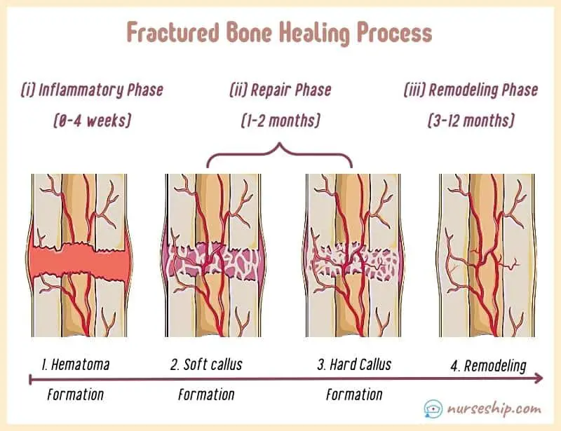 4-stages-of-bone-healing-process-3-stages-of-bone-healing-phases-timeline-weeks-fractured-bone-healing-process-broken-bone-healing-phase-times-time-bones-facture-what-is-types-repair-inflammatory-modeling-callus-injruy-trauma-slideshare