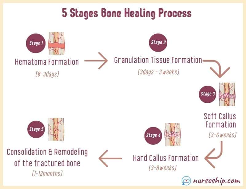 5-stages-of-bone-healing-process-bone-healing-timeline-weeks-fractured-bone-healing-process-broken-bone-healing-phases-times-time-fracture-bones-what-is-types-inflammatory-modeling-callus-injruy-trauma-slideshare